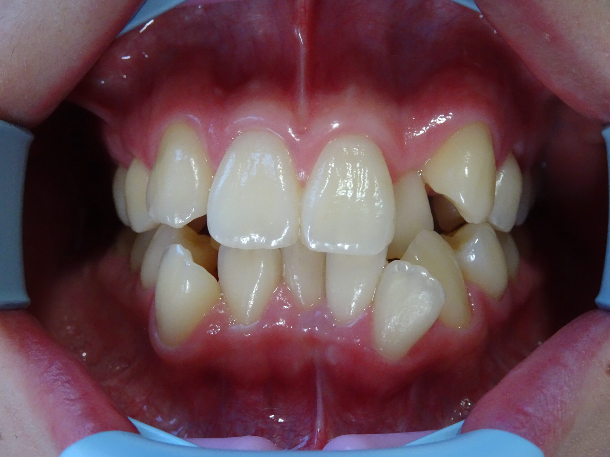 反対咬合　症例　before